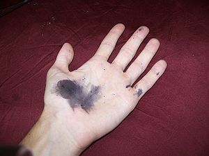 silver nitrate stain