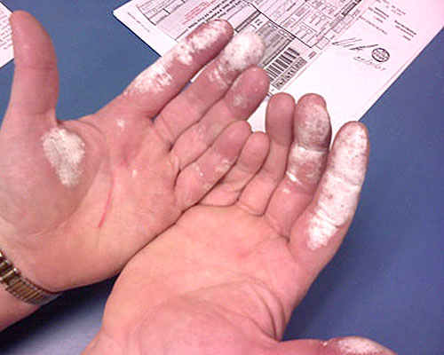 hands burned with H2O2